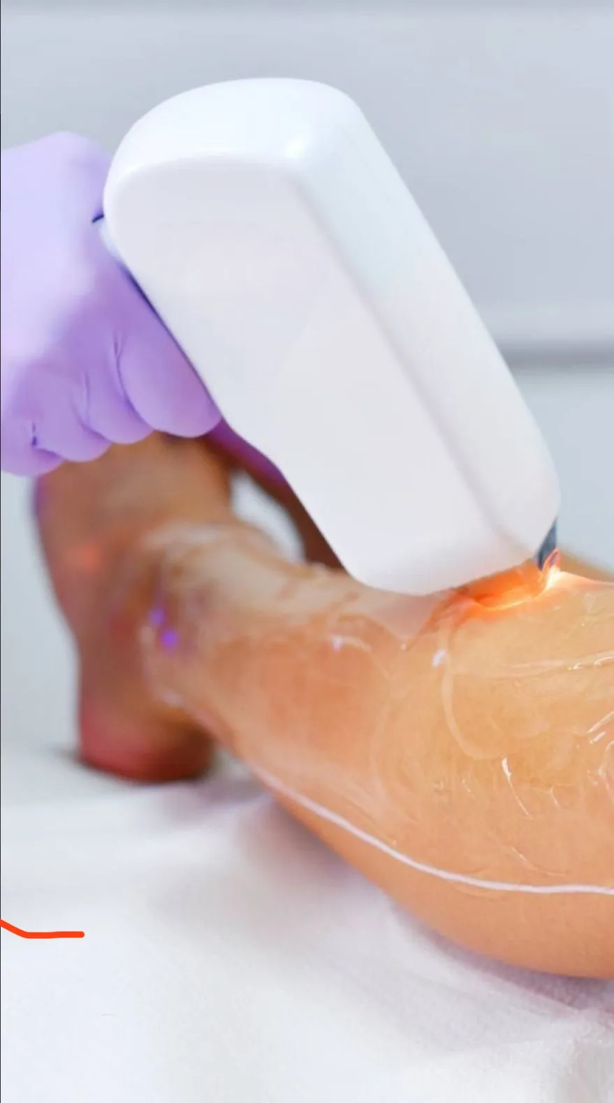 depilacion laser
